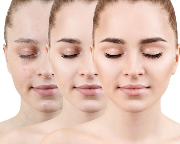 Women with increasingly clear skin after acne treatment